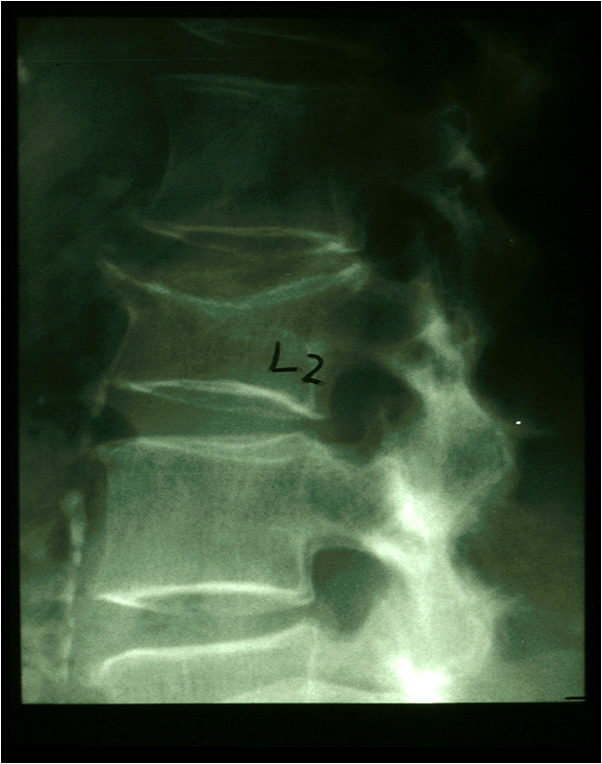 vertebral Compression fracture.png